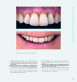 RESTORING THE INTRARADICULAR SPACE: ESTHETIC POST SYSTEMS 2021 - Image 8