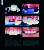 RESTORING THE INTRARADICULAR SPACE: ESTHETIC POST SYSTEMS 2021 - Image 9