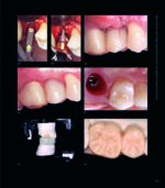 RESTORING THE INTRARADICULAR SPACE: ESTHETIC POST SYSTEMS 2021 - Image 10