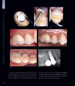 RESTORING THE INTRARADICULAR SPACE: ESTHETIC POST SYSTEMS 2021 - Image 11