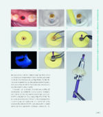 RESTORING THE INTRARADICULAR SPACE: ESTHETIC POST SYSTEMS 2021 - Image 12