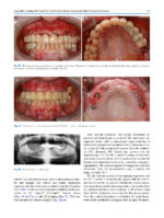 Atlas of Immediate Dental Implant Loading - Image 3