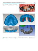 Atlas of Immediate Dental Implant Loading - Image 4
