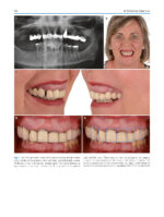 Atlas of Immediate Dental Implant Loading - Image 5