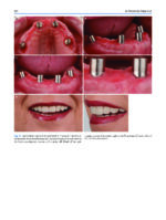 Atlas of Immediate Dental Implant Loading - Image 6