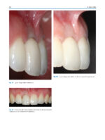 Atlas of Immediate Dental Implant Loading - Image 7