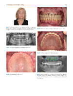 Atlas of Immediate Dental Implant Loading - Image 8