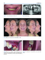 Atlas of Immediate Dental Implant Loading - Image 10