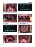 Atlas of Immediate Dental Implant Loading - Image 11