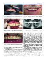 Atlas of Immediate Dental Implant Loading - Image 12