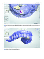 Atlas of Immediate Dental Implant Loading - Image 13