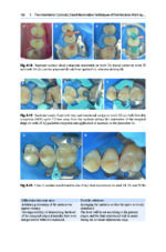 Direct Restorations: Clinical Steps for Working Protocols 2024 - Image 2
