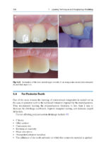 Direct Restorations: Clinical Steps for Working Protocols 2024 - Image 6