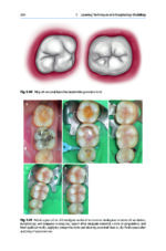 Direct Restorations: Clinical Steps for Working Protocols 2024 - Image 7