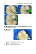 Direct Restorations: Clinical Steps for Working Protocols 2024 - Image 8