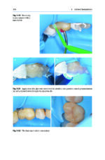 Direct Restorations: Clinical Steps for Working Protocols 2024 - Image 11