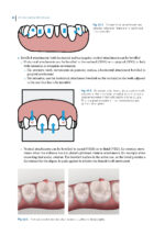 Aligner Techniques in Orthodontics 2021 - Image 2