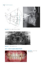 Aligner Techniques in Orthodontics 2021 - Image 3