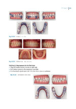Aligner Techniques in Orthodontics 2021 - Image 4