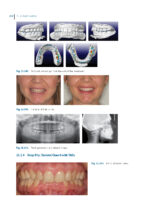 Aligner Techniques in Orthodontics 2021 - Image 6