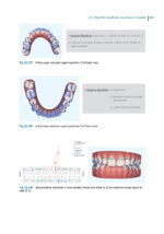 Aligner Techniques in Orthodontics 2021 - Image 7