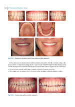 Aligner Techniques in Orthodontics 2021 - Image 10