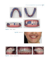 Aligner Techniques in Orthodontics 2021 - Image 11