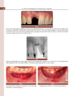 Treatment Planning Steps in Oral Implantology: A Color Atlas - Image 9