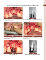 Treatment Planning Steps in Oral Implantology: A Color Atlas - Image 10