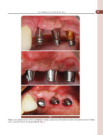 Treatment Planning Steps in Oral Implantology: A Color Atlas - Image 11