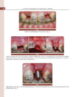 Treatment Planning Steps in Oral Implantology: A Color Atlas - Image 12