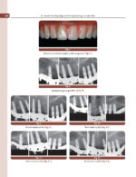 Treatment Planning Steps in Oral Implantology: A Color Atlas - Image 13