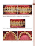 Treatment Planning Steps in Oral Implantology: A Color Atlas - Image 14
