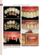 Treatment Planning Steps in Oral Implantology: A Color Atlas - Image 15