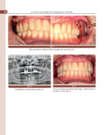 Treatment Planning Steps in Oral Implantology: A Color Atlas - Image 4