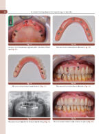 Treatment Planning Steps in Oral Implantology: A Color Atlas - Image 5