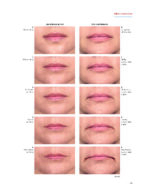 PRF in Facial Esthetics 2020 - Image 5
