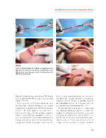 PRF in Facial Esthetics 2020 - Image 8
