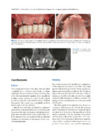 Zygoma Implants Step by Step 2023 - Image 9