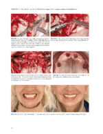 Zygoma Implants Step by Step 2023 - Image 10
