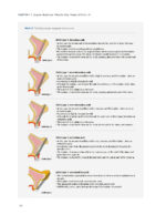 Zygoma Implants Step by Step 2023 - Image 3