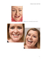 Zygoma Implants Step by Step 2023 - Image 5