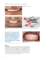 Zygoma Implants Step by Step 2023 - Image 6