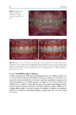 Tooth Whitening: An Evidence-Based Perspective 2023 - Image 9