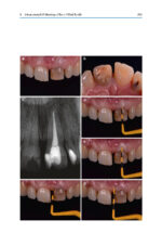 Tooth Whitening: An Evidence-Based Perspective 2023 - Image 5