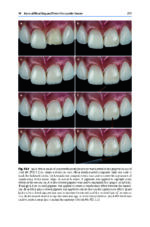 Tooth Whitening: An Evidence-Based Perspective 2023 - Image 10