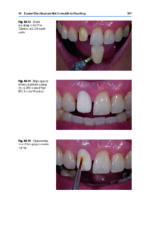 Tooth Whitening: An Evidence-Based Perspective 2023 - Image 11