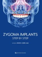 Zygoma Implants Step by Step 2023