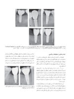 راهبردهای جلوگیری از تحلیل استخوان در ایمپلنت - Image 10