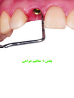 راهبردهای جلوگیری از تحلیل استخوان در ایمپلنت - Image 3